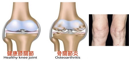 美國研究證實：「吉利丁」能緩解「骨關節炎」，不管是「關節疼痛」還是「硬化」都能減輕！