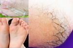 「腳跟乾裂」越磨越嚴重？3步驟「護足浸浴法」讓腳底老皮「改頭換面」，每天只要10分鐘！