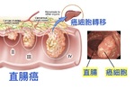 真實案例：每天一杯「抗癌蔬菜汁」，她9個月逆轉「直腸癌」末期！