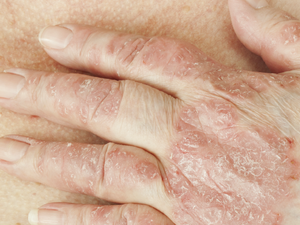 皮膚與指甲出現紅腫脫屑恐是免疫系統作祟！醫：生物製劑選擇有策略