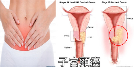 腿痛、貧血、尿道感染？小心隱形殺手「子宮頸癌」已盯上妳，四類女性更需注意！