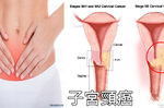 腿痛、貧血、尿道感染？小心隱形殺手「子宮頸癌」已盯上妳，四類女性更需注意！