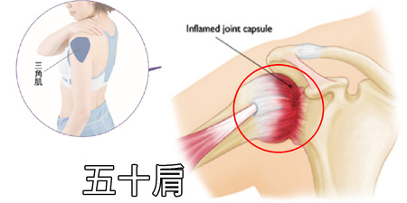 「三角肌」僵硬易導致「五十肩」：「伸展2招」立即消除疼痛，只需一條毛巾！