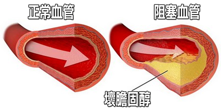 「壞膽固醇」才是堵塞血管的兇手！4種「降脂護心」食物這樣吃，動脈硬化自動消失！