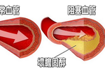 「壞膽固醇」才是堵塞血管的兇手！4種「降脂護心」食物這樣吃，動脈硬化自動消失！