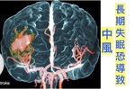 「90%」的失眠者「病痛纏身」，小心無預警中風！「30秒」入睡法，逆轉失眠體質，通殺「八」大致命疾病威脅！