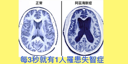 每3秒就多1人「失智」！遵循簡單「四吃」「四做」黃金原則，失智風險速降50%！