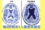 每3秒就多1人「失智」！遵循簡單「四吃」「四做」黃金原則，失智風險速降50%！