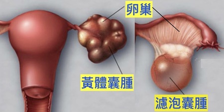 「脹氣」、「下背痛」、「頭暈」？小心「卵巢囊腫」！立刻自我檢測，拒吃「五」大食品，逆轉囊腫危機！