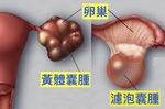 「脹氣」、「下背痛」、「頭暈」？小心「卵巢囊腫」！立刻自我檢測，拒吃「五」大食品，逆轉囊腫危機！