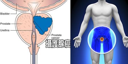 「攝護腺癌」發作率升高32%：自測攝護腺癌「五大徵兆」，拒吃10種食物保護下半身！