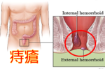 注意，上廁所時「滑手機」等同殘害「腸道」：靜脈曲張跟「痔瘡」都是這樣「蹲」出來的！