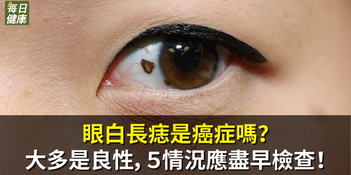 眼白長痣是癌症嗎？眼醫：大多是良性，５情況應盡早檢查！