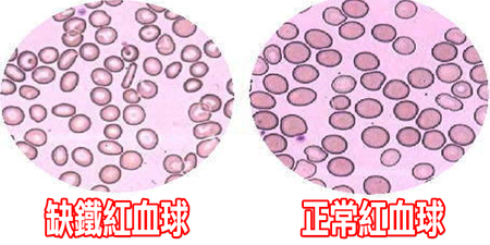 經常性掉髮、心悸、頭暈？全是「缺鐵性貧血」惹的禍：五種「補鐵食物」這樣吃，遠離「貧血人生」不用等！