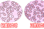 經常性掉髮、心悸、頭暈？全是「缺鐵性貧血」惹的禍：五種「補鐵食物」這樣吃，遠離「貧血人生」不用等！