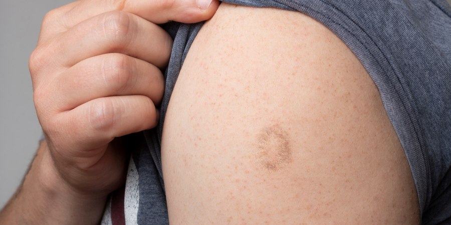 「猴痘」是否要施打疫苗？　看看手臂辨識卡介疤還是牛痘疫苗