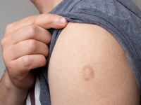 「猴痘」是否要施打疫苗？　看看手臂辨識卡介疤還是牛痘疫苗