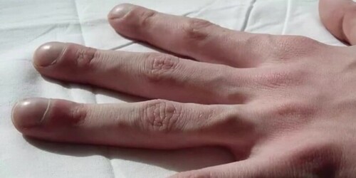 別小看指甲變形！簡單測試「杵指狀」恐患肺癌早期