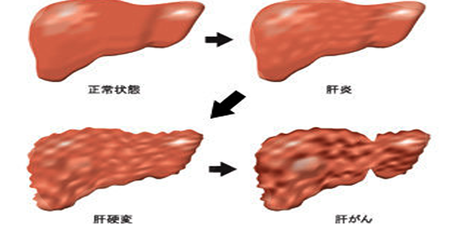 你要讓「肝臟」被「雌激素」荼毒多久？三大護肝食材這樣煮，排空肝臟毒素用「喝」的！