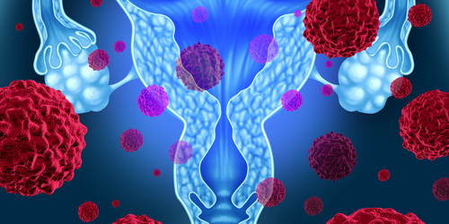 子宮肌瘤可能造成不孕、流產　中醫師曝「活血化瘀」治療方法