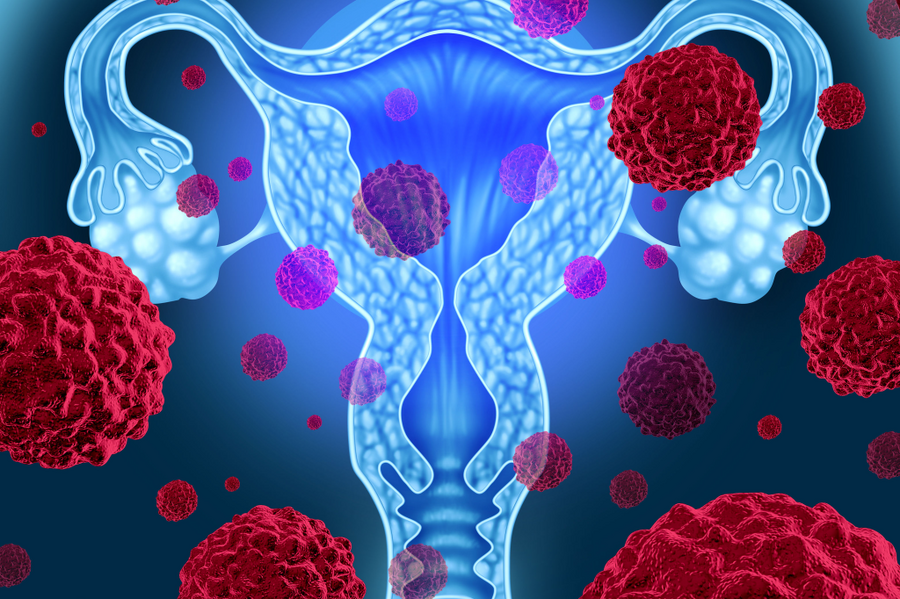 子宮肌瘤可能造成不孕、流產　中醫師曝「活血化瘀」治療方法