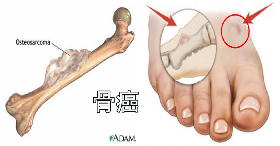 關節腫痛 骨頭痠痛 不可輕忽 7種症狀當心 骨癌 已潛伏體內 家有 青少年 更需注意 每日健康health