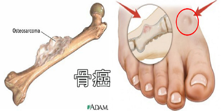 關節腫痛、「骨頭痠痛」不可輕忽：7種症狀當心「骨癌」已潛伏體內，家有「青少年」更需注意！