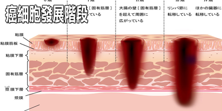 破解「癌細胞」的生長密碼：做對「六件事」清光體內致癌物，「癌症」與你從此絕緣！