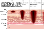 破解「癌細胞」的生長密碼：做對「六件事」清光體內致癌物，「癌症」與你從此絕緣！