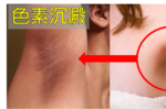 腋下「黑黑的」好尷尬！一秒學會「5招腋下美白術」立即揮別色素沉澱，再也不怕穿無袖，舉手投足充滿自信！