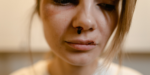 中年婦女額頭「小刮痕」慢慢長大成「火山口」檢查才發現是癌症！　悔哭：年輕不知防曬重要