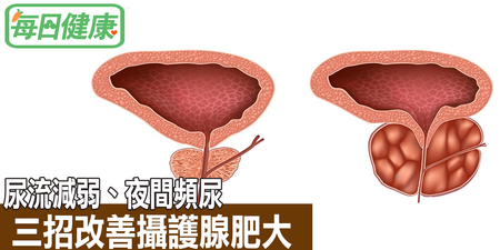 尿流減弱、夜間頻尿很困擾？三招自救「攝護腺肥大」，找回「順暢無比」的下半身健康！