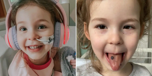 3歲女童舌頭突然「長黑痣」　醫師診斷：致命骨髓血液病