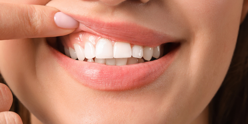 洗牙害「牙縫變大」？牙醫解迷思：牙縫露出、牙齦消腫的錯覺