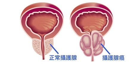 攝護腺癌都是自己「餵」出來的！一分鐘快速檢測，拒吃五大食物，越吃攝護腺越腫，癌細胞越多！