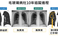 10年X光未發現！男子LDCT檢查揪出肺癌　醫師提醒：五種症狀就要當心