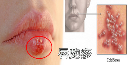 「唇皰疹」又痛又醜怎麼辦？使用「6種天然材料」擊退病毒，輕輕敷、快快好，兩天見效！