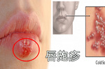 「唇皰疹」又痛又醜怎麼辦？使用「6種天然材料」擊退病毒，輕輕敷、快快好，兩天見效！