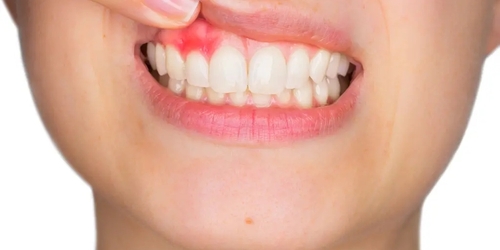 牙齦腫脹6大成因曝！牙醫揭「超常見族群」易遭殃：1習慣恐釀惡性循環