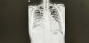 不抽菸也中招！36歲男「肺癌腦轉移」壽命剩3個月　醫曝1關鍵技術：活下來了