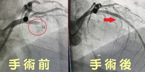 45歲健康男子竟突心絞痛昏倒　醫關鍵72分鐘搶救傻眼：「1動脈100%阻塞」