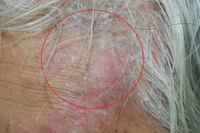 左側頭痛像遭雷擊！72歲男「額頭紅腫」竟是帶狀疱疹　醫曝三原因誘發