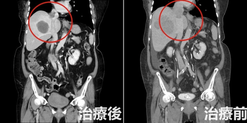 79歲婦腿腫爬樓梯狂喘！就醫驚見「13公分巨瘤+7公分血栓」　醫：晚期了