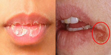 嘴唇「乾裂脫皮」、口角炎不是因為缺水，別再猛塗護唇膏！補充「4種營養素」才能治標又治本！