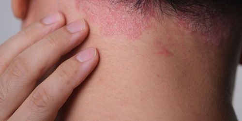 乾癬治療不再中途下車！ 新型口服標靶小分子藥物納健保，她樂喊「終於能穿短袖出門」