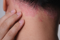 乾癬治療不再中途下車！ 新型口服標靶小分子藥物納健保，她樂喊「終於能穿短袖出門」