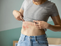 生活壓力大恐增皮蛇風險！?　新竹人請注意