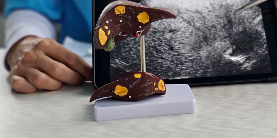 體重、BMI都正常，健檢卻驗出「脂肪肝」？醫：「泡芙人｣快做1件事改善紅字