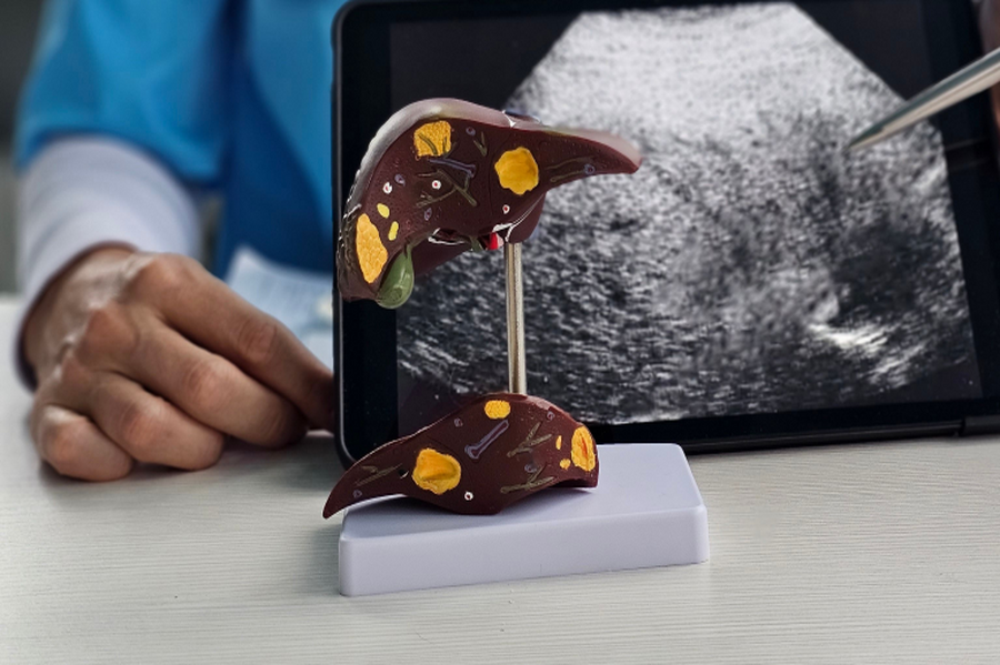 體重、BMI都正常，健檢卻驗出「脂肪肝」？醫：「泡芙人｣快做1件事改善紅字