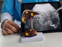 體重、BMI都正常，健檢卻驗出「脂肪肝」？醫：「泡芙人｣快做1件事改善紅字